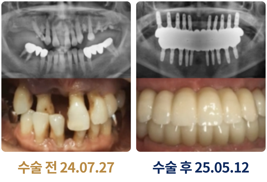 전체 임플란트 사례 3