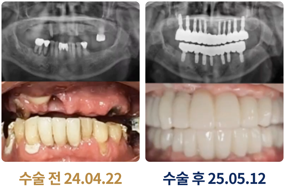 전체 임플란트 사례 4